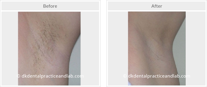 Dermal Fillers