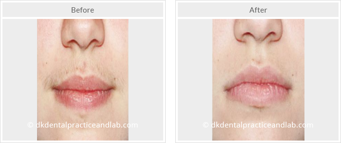 Dermal Fillers