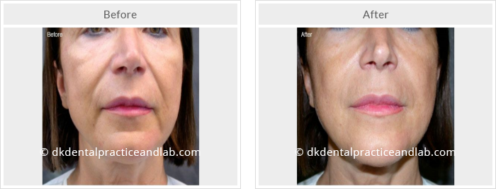 Dermal Fillers