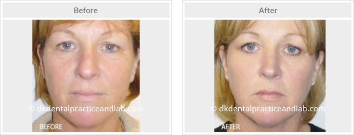 Dermal Fillers