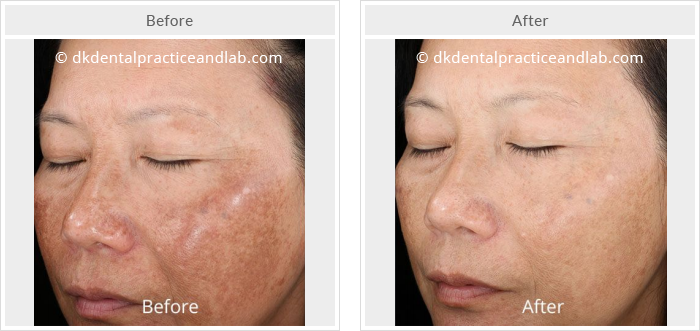 Skin Tightening