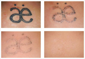 Tattoo Removal Weymouth, Dorset - DK Dental Practice & Lab