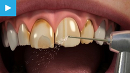 Porcelain Veneers